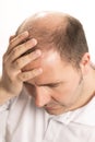 Baldness Alopecia man hair loss isolated Royalty Free Stock Photo