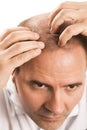 Baldness Alopecia man hair loss isolated Royalty Free Stock Photo