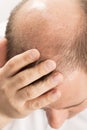 Baldness Alopecia man hair loss Royalty Free Stock Photo