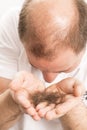 Baldness Alopecia man hair loss Royalty Free Stock Photo