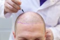 Baldness treatment. Patient suffering from hair loss in consultation with a doctor. Preparation for hair transplant Royalty Free Stock Photo