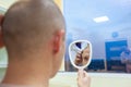 Baldness treatment. Patient suffering from hair loss in consultation with a doctor. Preparation for hair transplant Royalty Free Stock Photo