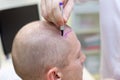 Baldness treatment. Patient suffering from hair loss in consultation with a doctor. Preparation for hair transplant Royalty Free Stock Photo