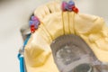 Ball attachment for denture Royalty Free Stock Photo