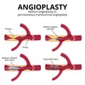 Balloon angioplasty Royalty Free Stock Photo