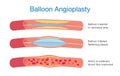 Balloon angioplasty procedure