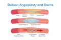 Balloon angioplasty and stents procedure Royalty Free Stock Photo