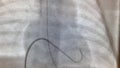 Balloon dilatation of the pulmonary artery valve