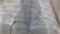 Balloon dilatation of the pulmonary artery valve