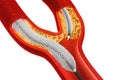 Balloon Expandable Stent. Anatomical concept Royalty Free Stock Photo