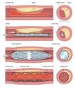 stent implantation Royalty Free Stock Photo