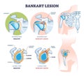 Bankart lesion as anterior part of the glenoid labrum trauma outline diagram Royalty Free Stock Photo