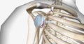 A Bankart lesion occurs as the result of a forward shoulder dislocation Royalty Free Stock Photo