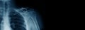 Banner shoulder x-ray Royalty Free Stock Photo