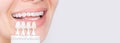 Banner tooth whitening, perfect white teeth close up with shade guide bleach color, female veneer smile, dental care and