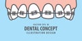 Banner Upper Braces teeth illustration vector on blue background