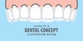 Banner Upper Essix retainer illustration vector on blue background. Dental concept.