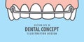 Banner Upper Hawley retainer illustration vector on blue background. Dental concept.