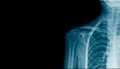 Banner x-ray shoulder joint