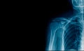 Banner x-ray shoulder joint Royalty Free Stock Photo