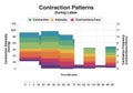 Bar graph illustrating contraction patterns during labor over 60 minutes. The x-axis represents Royalty Free Stock Photo