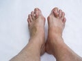 Bare foots which have Hallux Valgus bunion problem