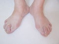 Bare foots which have Hallux Valgus problem.