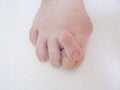 Bare foots which have Hallux Valgus problem.