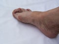 Bare foots which have Hallux Valgus problem.