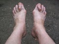 Bare foots which have Hallux Valgus problem.