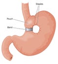 Bariatric surgery