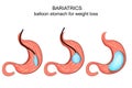 Bariatrics. balloon stomach for weight loss