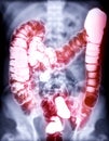 Barium enema or BE is image of large bowel