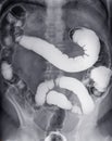 Barium enema or BE is image of large bowel .