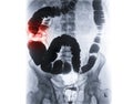 Barium enema or BE is image of large bowel after injection of barium contrast fill into colon under fluoroscopic control