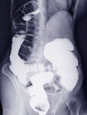 Barium enema or BE is image of large bowel .