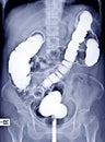 Barium enema image AP View showing the colon and rectum under fluoroscopic control . Royalty Free Stock Photo