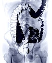 Barium enema image or BE left lateral decubitus