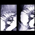 barium enema image of x-ray image of large bowel