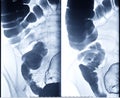 Barium enema image or x-ray image of large intestine or colon.