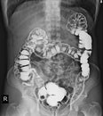 Barium enema of a man demonstrated the normal rectum and cecum.