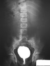 Barium enema of a patient, demonstrated obstruction of contrast media at rectal region and irregular rectal mucosa.