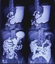 Barium meal and follow through examination x-ray. showing digestive system.