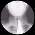 Barium swallow Evidence of achalasia at distal esophagus to EG junction.Moderate proximal dialtation of esophagus with