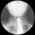 Barium swallow Evidence of achalasia at distal esophagus to EG junction.Moderate proximal dialtation of esophagus with