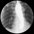 Barium swallow Evidence of achalasia at distal esophagus to EG junction.Moderate proximal dialtation of esophagus with Royalty Free Stock Photo