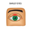 Barley eyes. Purulent inflammation.