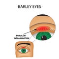 Barley eyes. Purulent inflammation.