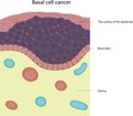 Basal cell cancer. Skin disease. Tumor cells.