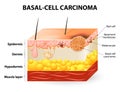 Basal-cell carcinoma or basal cell cancer